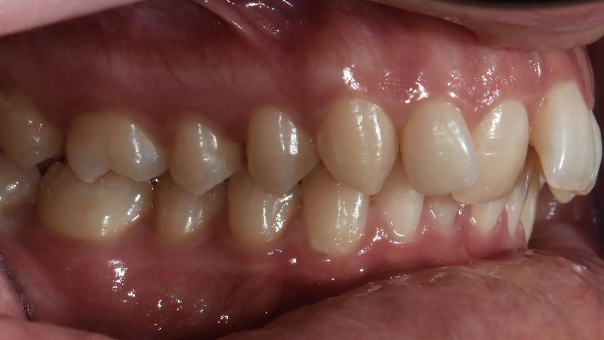 allineamento denti savona 20