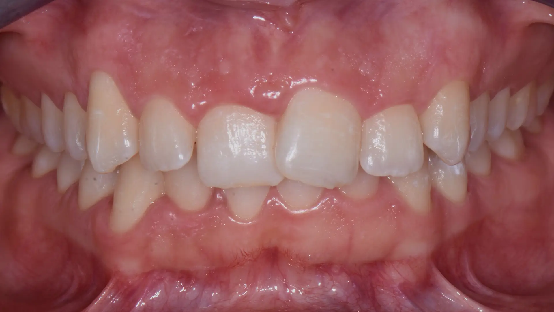 allineamento denti savona 21