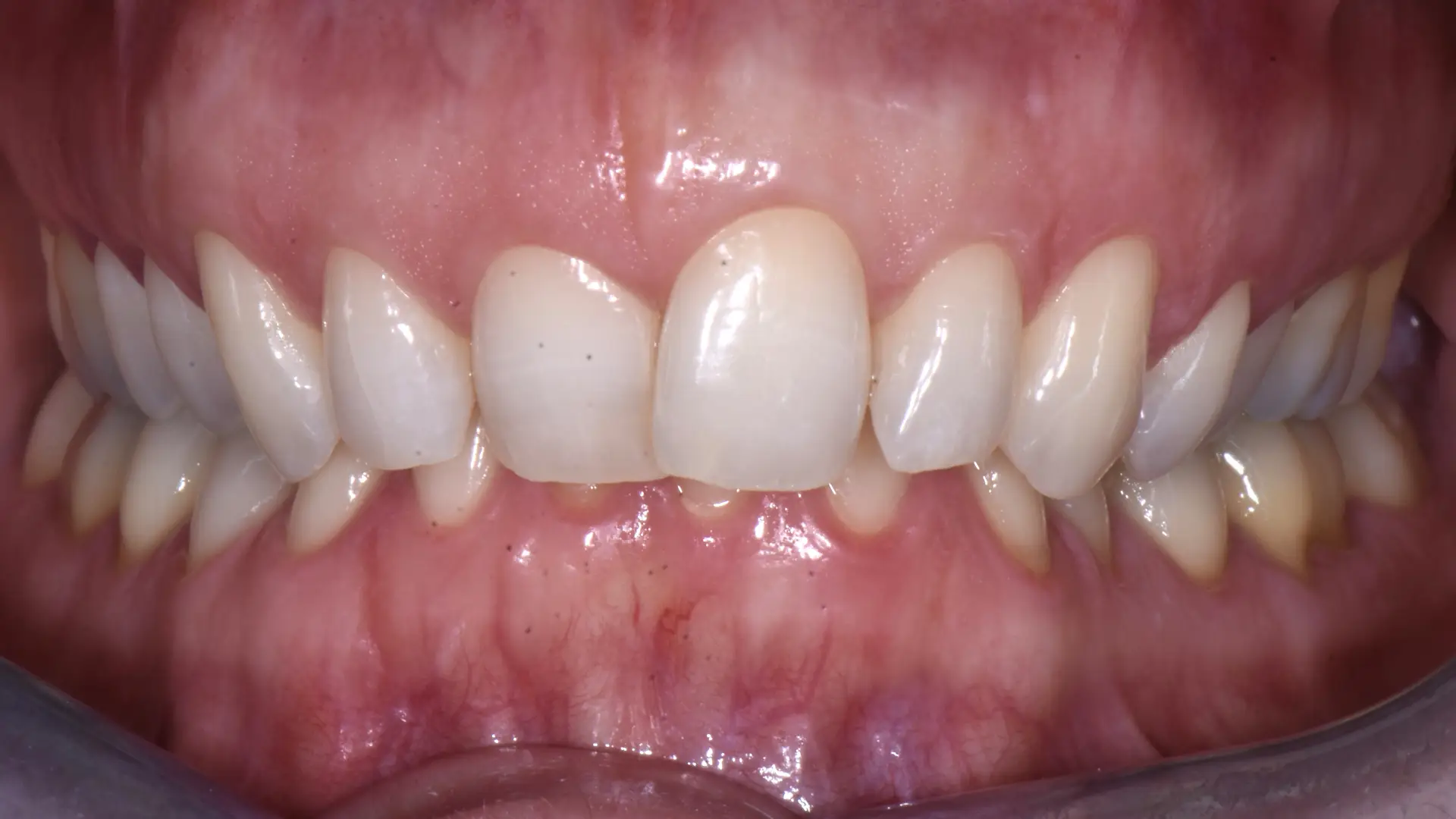 allineamento denti savona 22