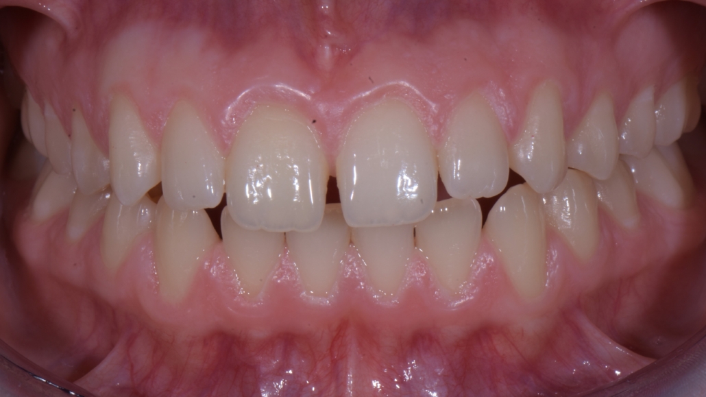 allineamento denti savona 23