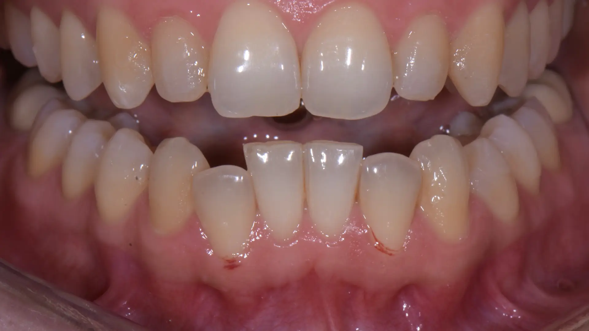 allineamento denti savona 24