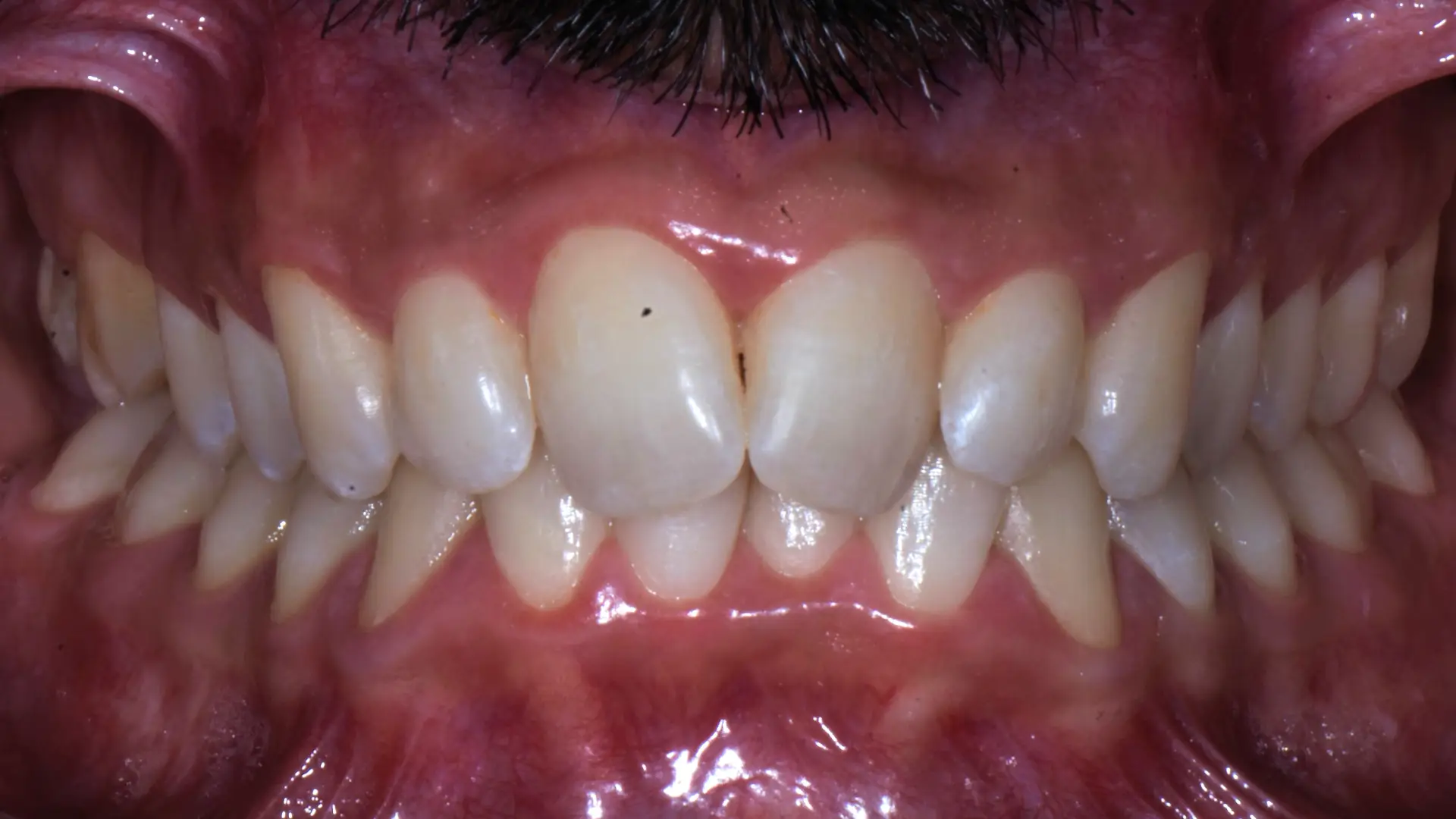 allineamento denti savona 25